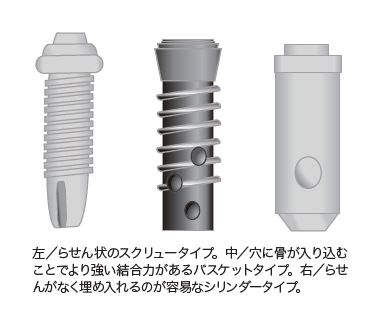 どのインプラントを使うか 知っておきましょう!