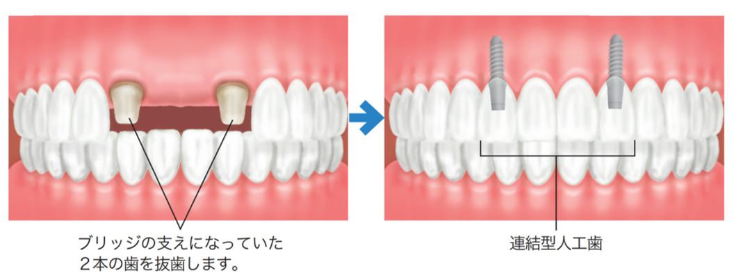インプラント治療の例 (①基本的な症例)