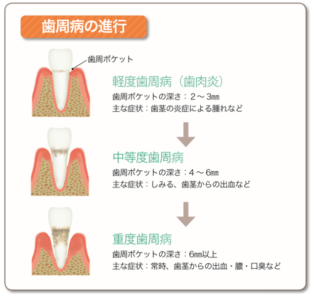 歯を失う原因を探ってみましょう