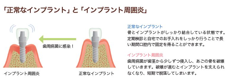 「インプラント周囲炎」の 症状と検査・治療法