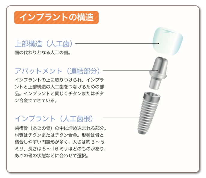 インプラントの基本構造と基本的な治療方法