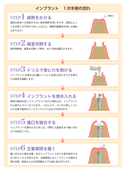 インプラントを埋め入れる2回法の1次手術とは?