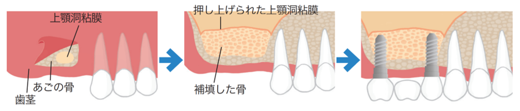 インプラント治療の例 (②難症例)