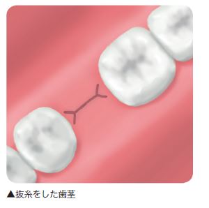 治療後の正しいお手入れを解説