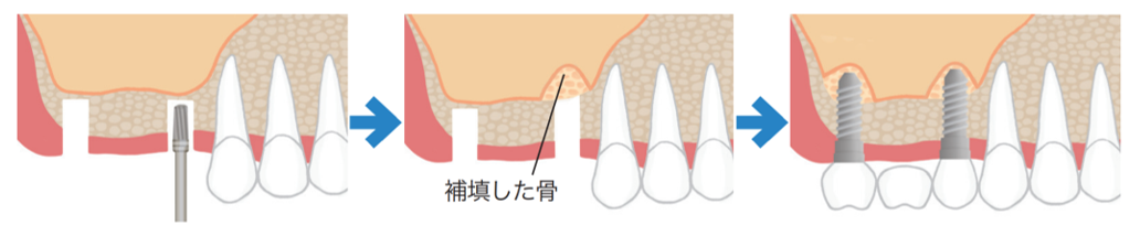 インプラント治療の例 (②難症例)