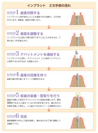 インプラントを埋め入れる2回法の2次手術とは?