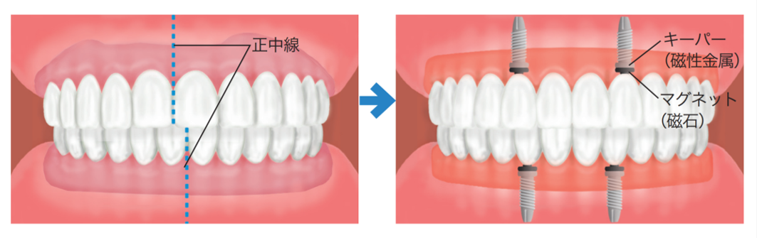 インプラント治療の例 (①基本的な症例)