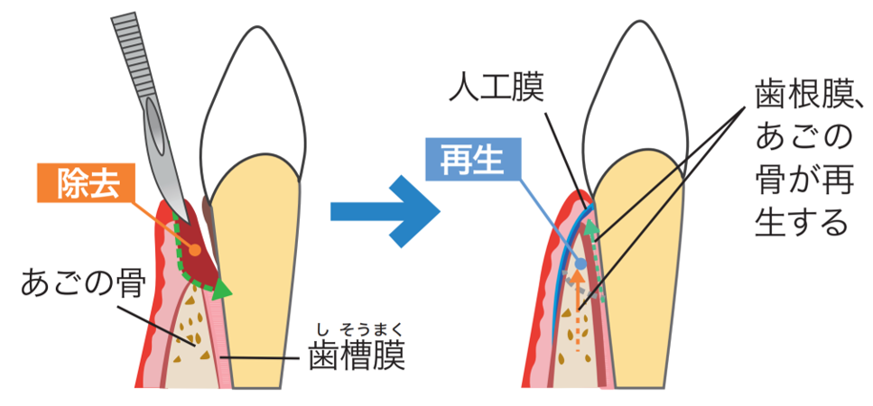 インプラント治療の例 (②難症例)