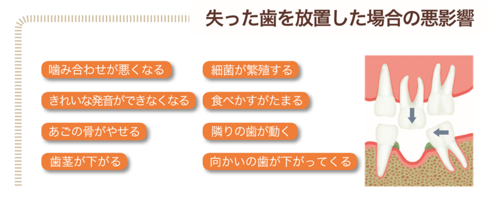 失った歯を補うさまざまな治療法