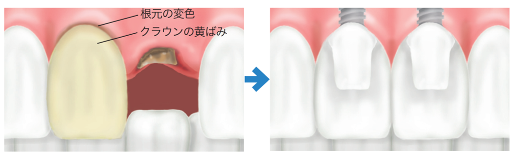 インプラント治療の例 (①基本的な症例)