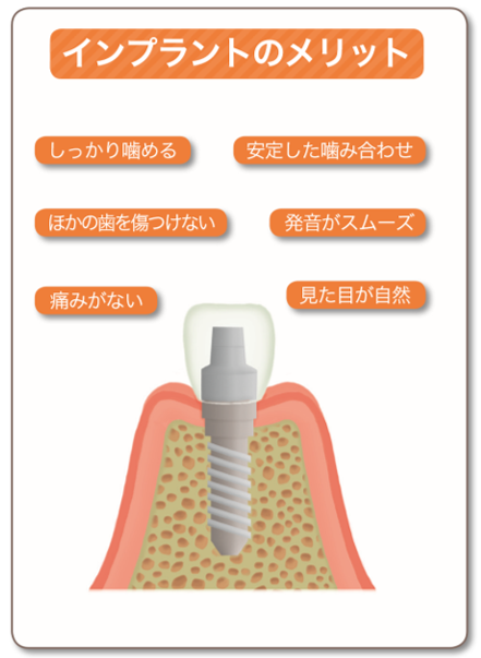 インプラント治療のメリットと特徴