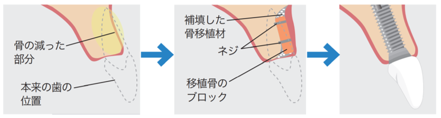 インプラント治療の例 (②難症例)