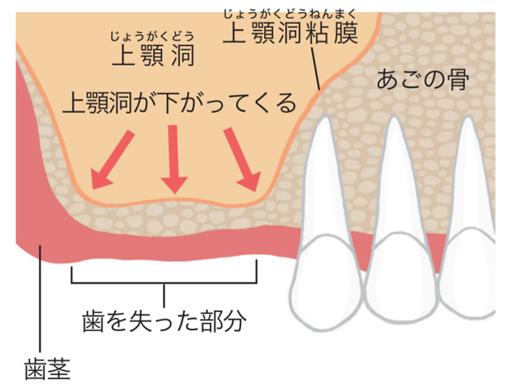 インプラント治療の例 (②難症例)