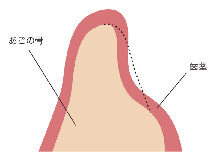 インプラント治療の例 (②難症例)