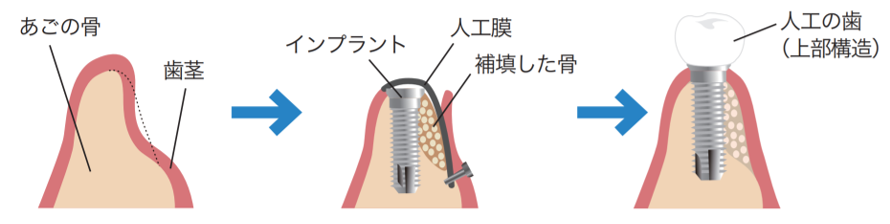 インプラント治療の例 (②難症例)