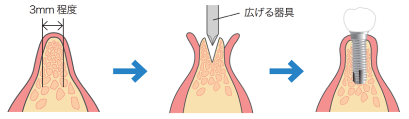 インプラント治療の例 (②難症例)